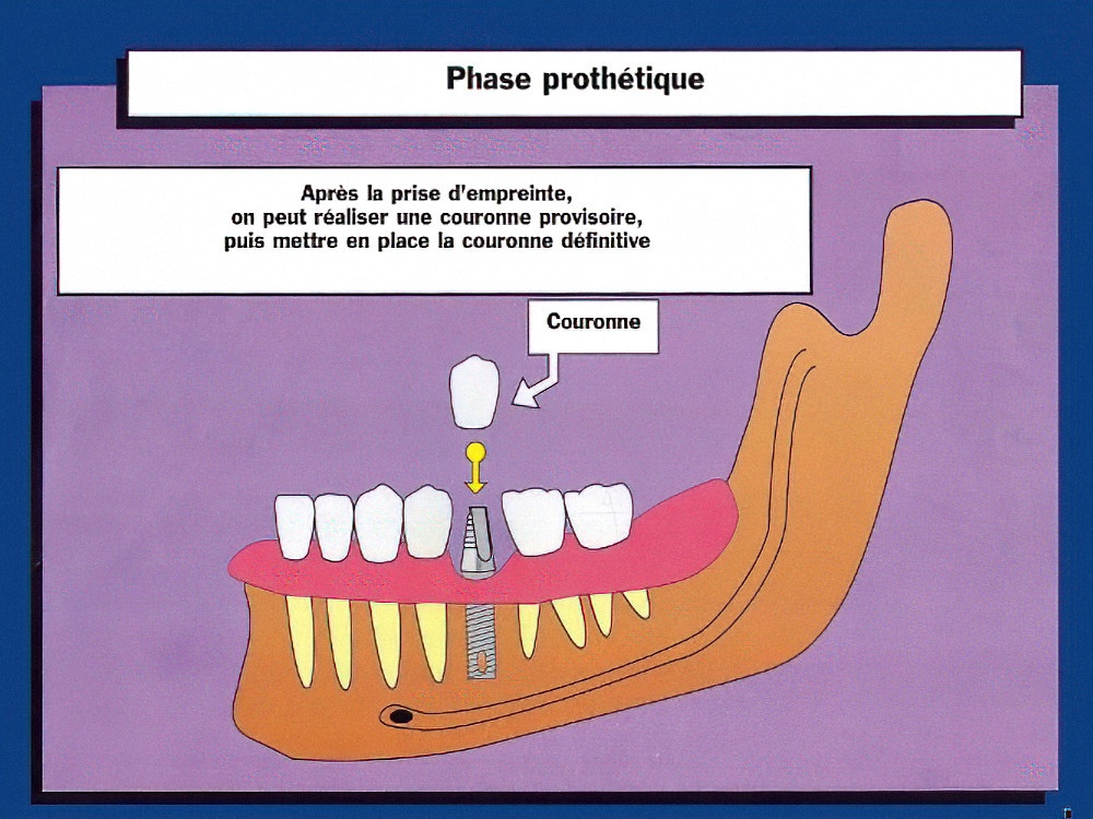 couronne sur implant dentaire strasbourg